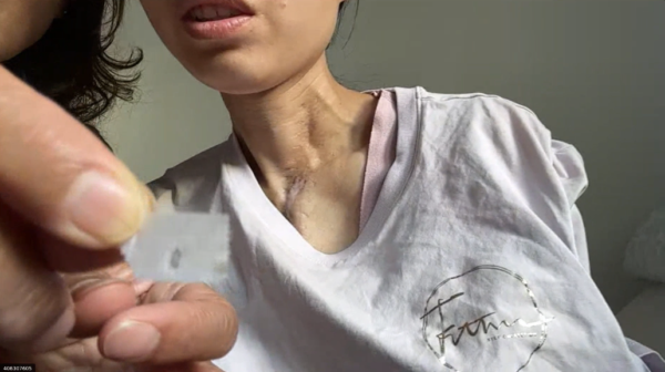 张琦母亲杜廷香一直在照顾女儿生活,她展现郑州大学附设医院用的医用针。(视频采访截图)
